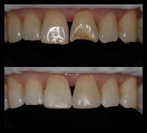 Estetinis plombavimas 2