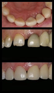 Estetinis plombavimas 4