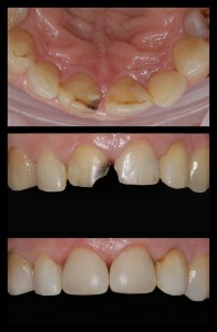 Estetinis plombavimas 5